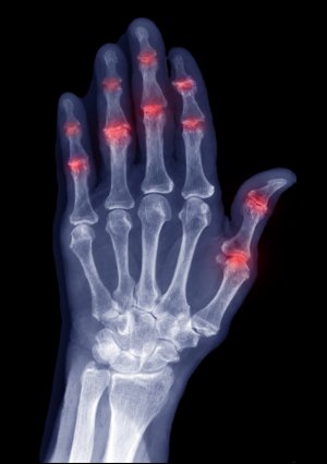 Bilde: ሶርያቲክ ኣርትራይተስ/ ሕማም መላግቦ